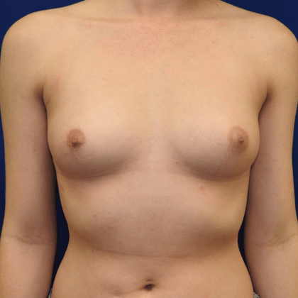 Before Breast Augmentation in Nashville with Dr. Paul Papillion