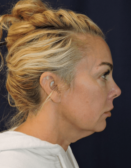Facelift Before & After Photos