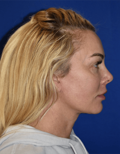 Facelift Before & After Photos