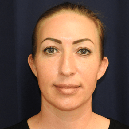 Otoplasty Before & After Photos