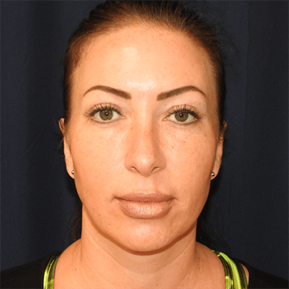 Otoplasty Before & After Photos