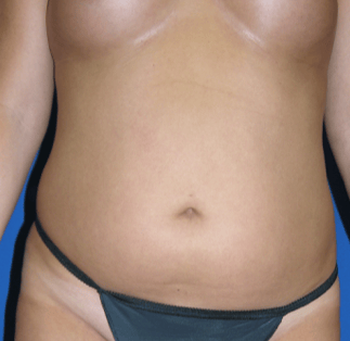 Abdominoplasty Before & After Results
