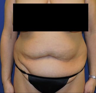 Abdominoplasty Before & After Results