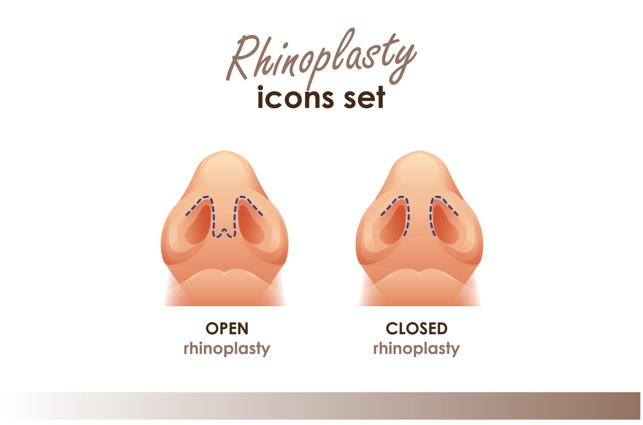 Rhinoplasty diagram showing nasal structure and surgical adjustments