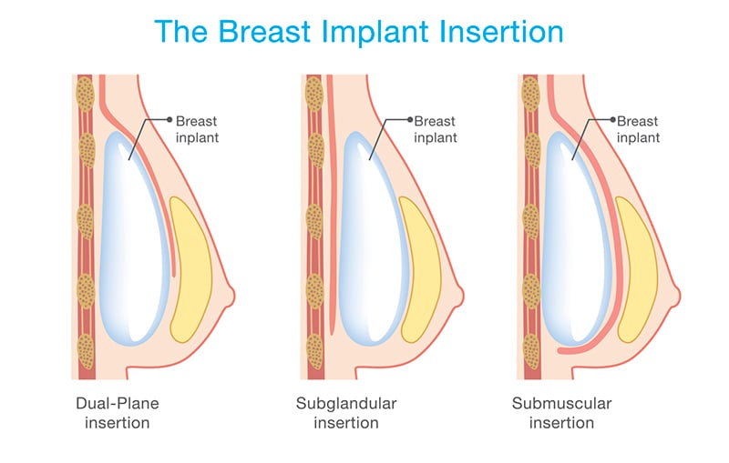 Breast Implant Placement Options