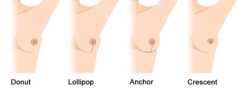 Incision Options for Breast Augmentation with Lift