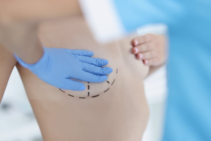 Day of Breast Augmentation with Breast Lift Surgery