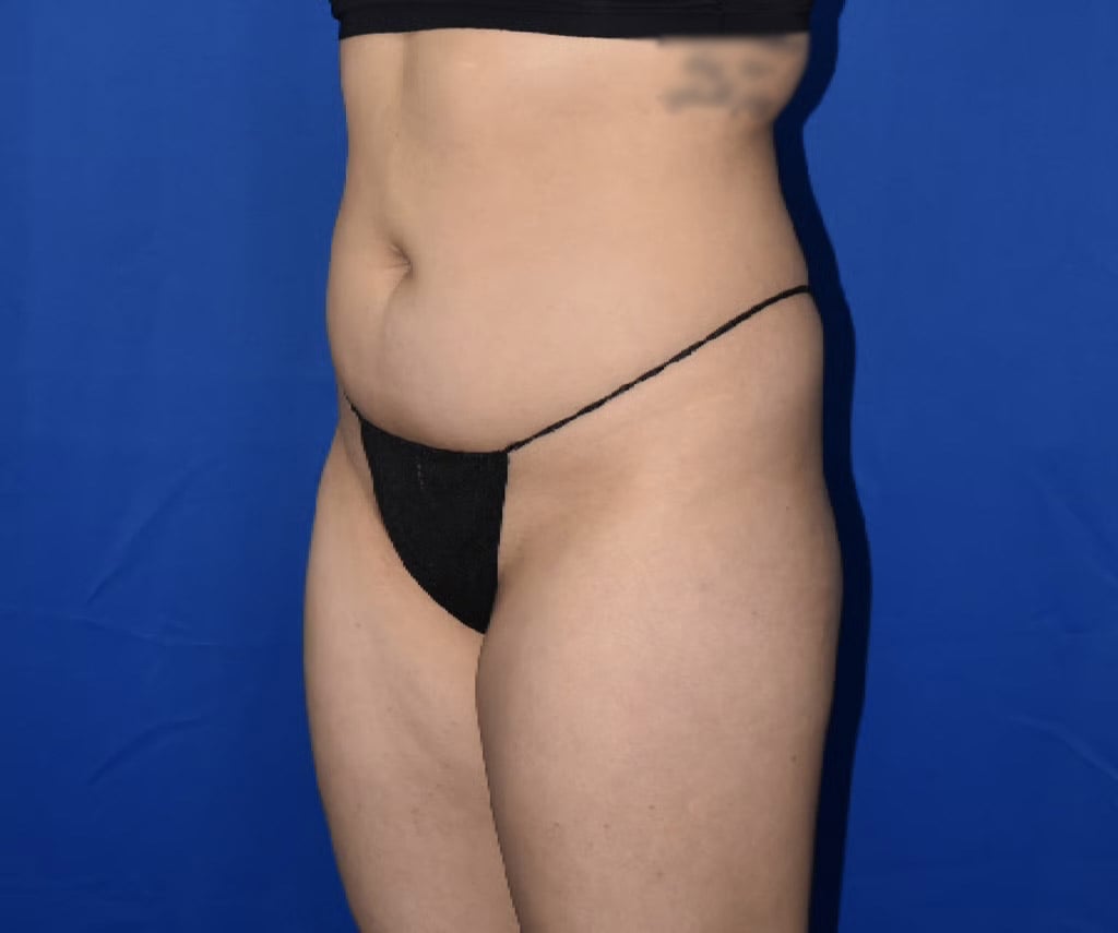 Liposuction 360 LO Before 17338