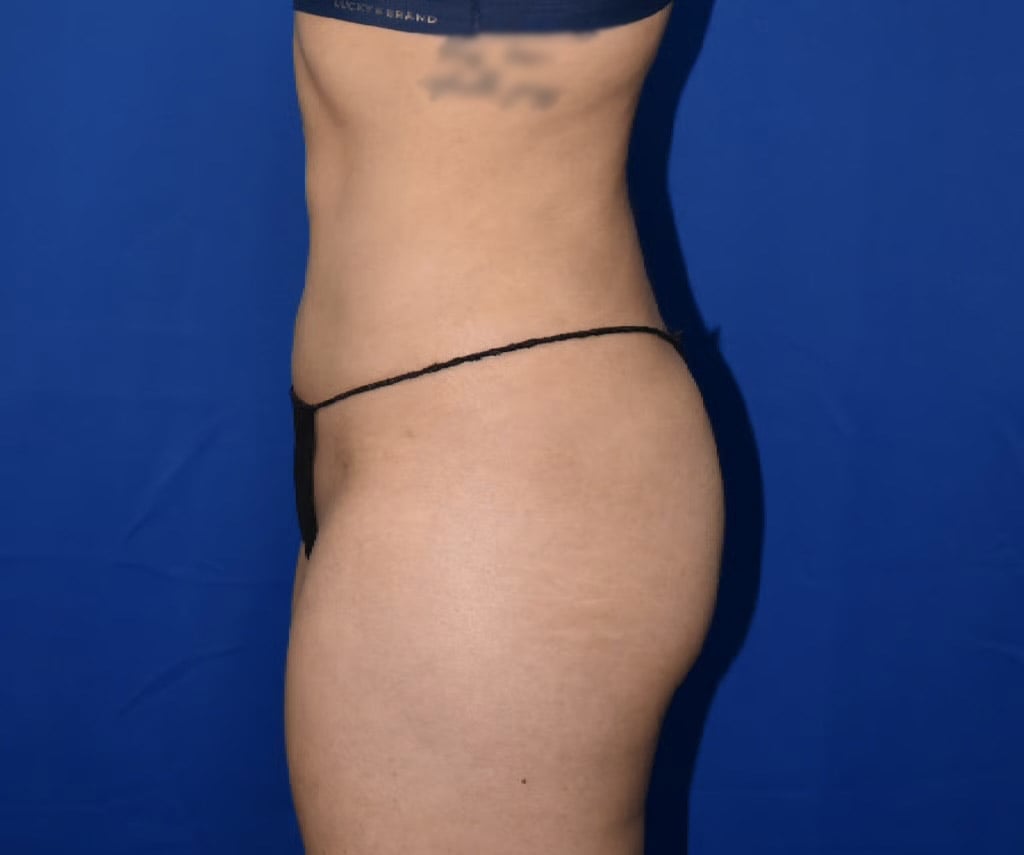 Liposuction 360 SL After 17338
