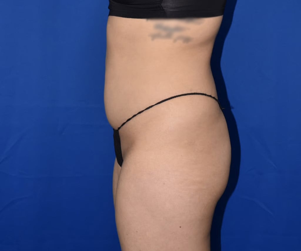 Liposuction 360 SL Before 17338