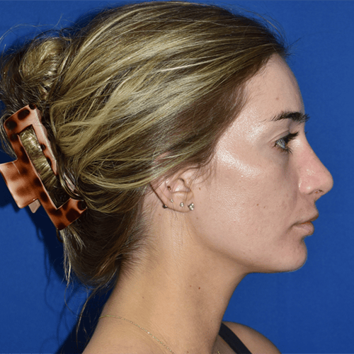11045 Rhinoplasty