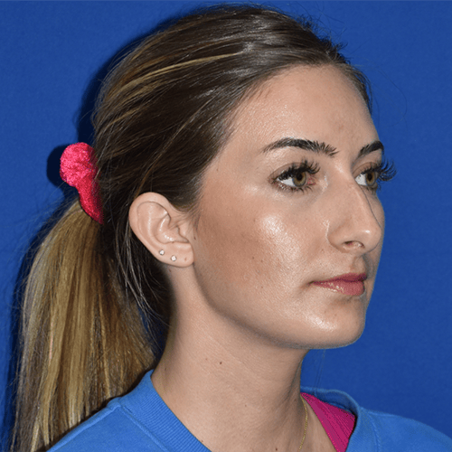 11045 Rhinoplasty