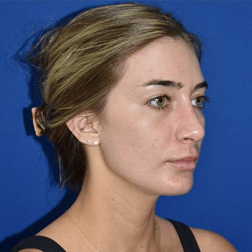 11045 Rhinoplasty
