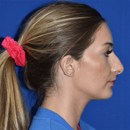 11045 Rhinoplasty