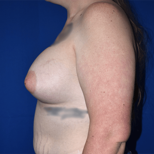 11903 Breast Augmentation after left side view