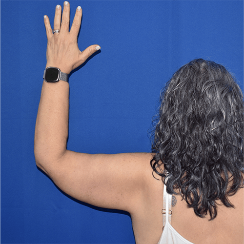 back left view after brachioplasty