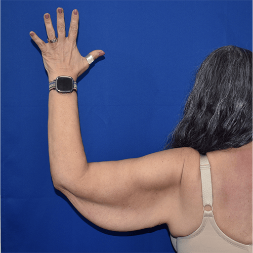 back left view before brachioplasty