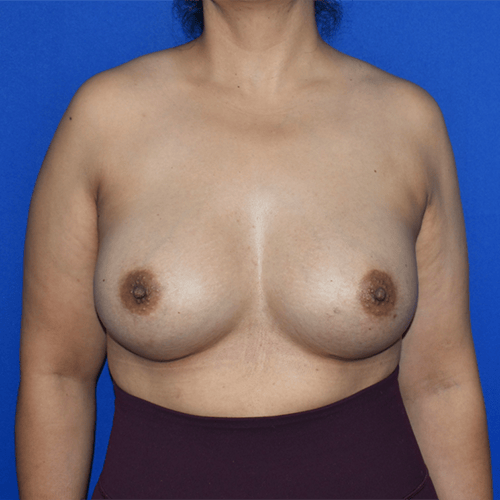 front view after breast augmentation