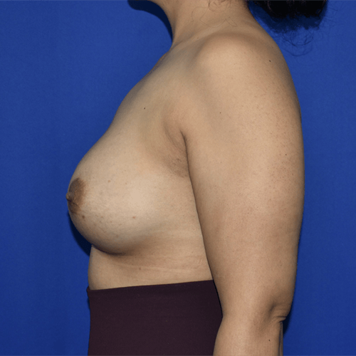 left side view after breast augmentation