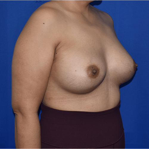 right oblique view after breast augmentation