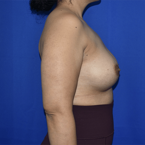 right side view after breast augmentation