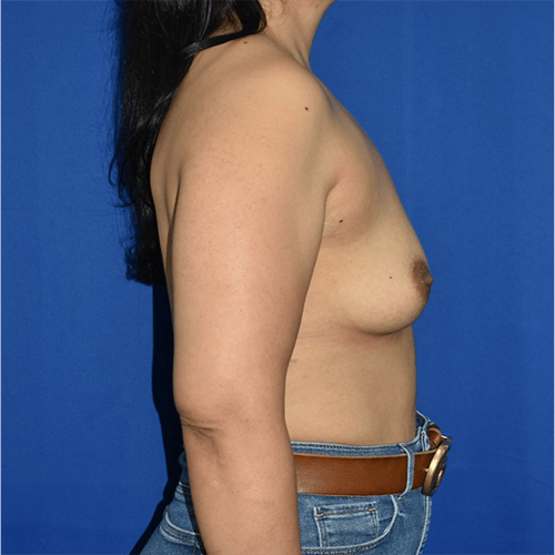 right side view before breast augmentation