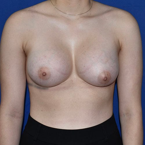 front view after breast augmentation by dr papillion 11421