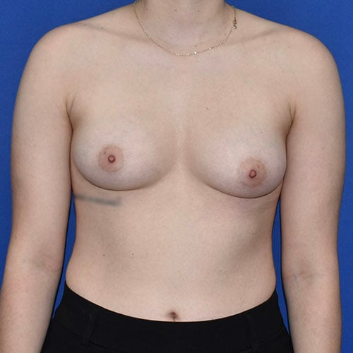 front view before breast augmentation by dr papillion 11421
