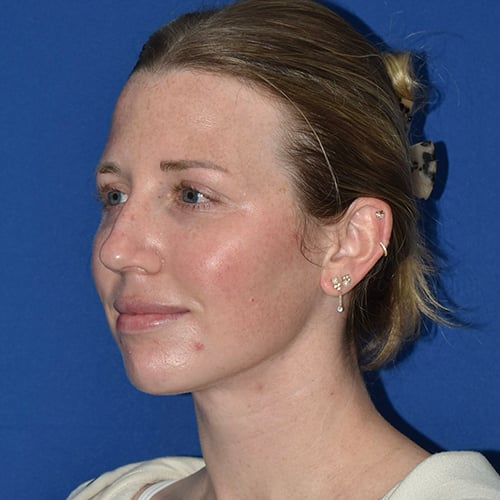 left oblique view after chin liposuction by dr papillion 12566