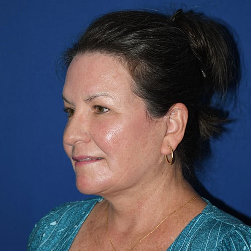 left oblique view after facelift, CO2 laser and facial fat grafting by dr papillion 12844