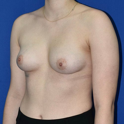 left oblique view before breast augmentation by dr papillion 11421