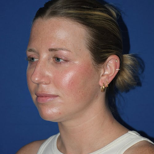 left oblique view before chin liposuction by dr papillion 12566
