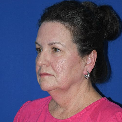 left oblique view before facelift, CO2 laser and facial fat grafting by dr papillion 12844