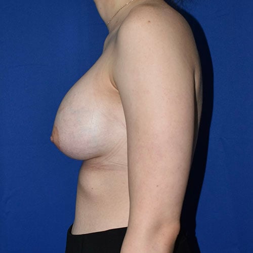left side view after breast augmentation by dr papillion 11421