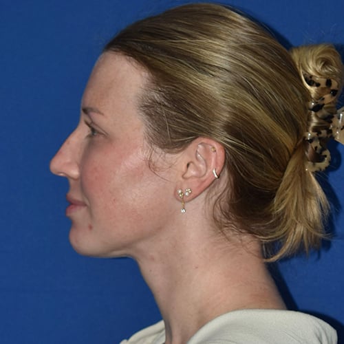 left side view after chin liposuction by dr papillion 12566