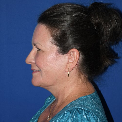 left side view after facelift, CO2 laser and facial fat grafting by dr papillion 12844