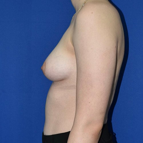 left side view before breast augmentation by dr papillion 11421