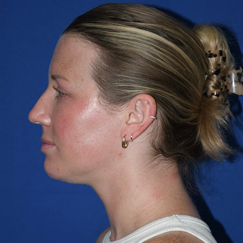 left side view before chin liposuction by dr papillion 12566