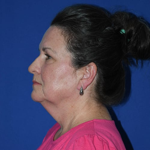 left side view before facelift, CO2 laser and facial fat grafting by dr papillion 12844