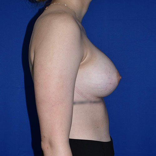 right side view after breast augmentation by dr papillion 11421