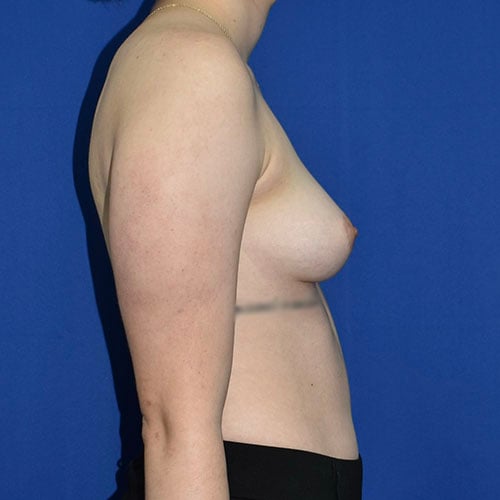 right side view before breast augmentation by dr papillion 11421
