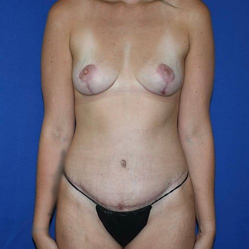 front view after abdominoplasty and breast lift by dr papillion 12536