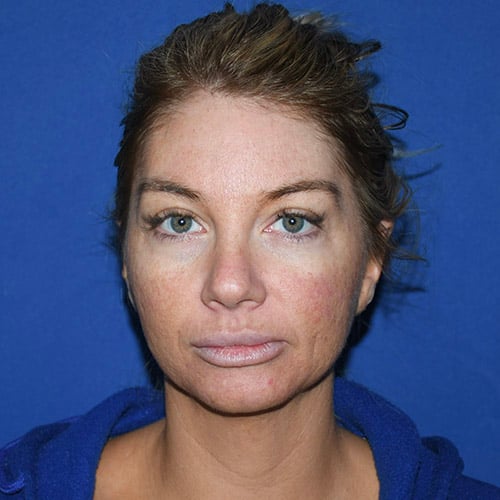front view after otoplasty and chin liposuction by dr papillion 12555