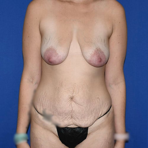 front view before abdominoplasty and breast lift by dr papillion 12536