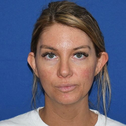 front view before otoplasty and chin liposuction by dr papillion