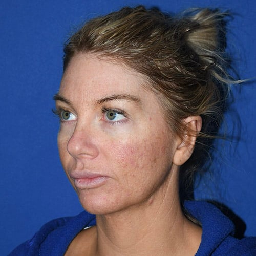 left oblique view after otoplasty and chin liposuction by dr papillion 12555