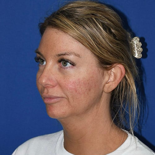 left oblique view before otoplasty and chin liposuction by dr papillion 12555
