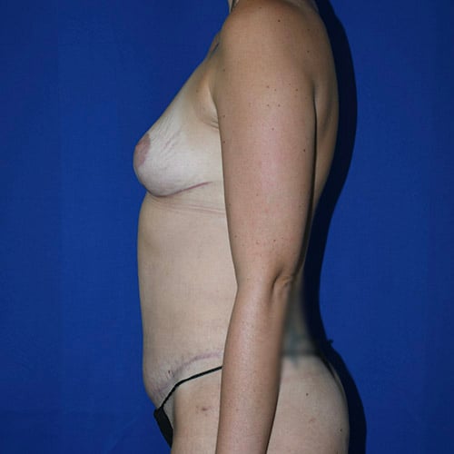 left side view after abdominoplasty and breast lift by dr papillion 12536