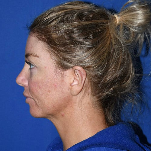 left side view after otoplasty and chin liposuction by dr papillion 12555