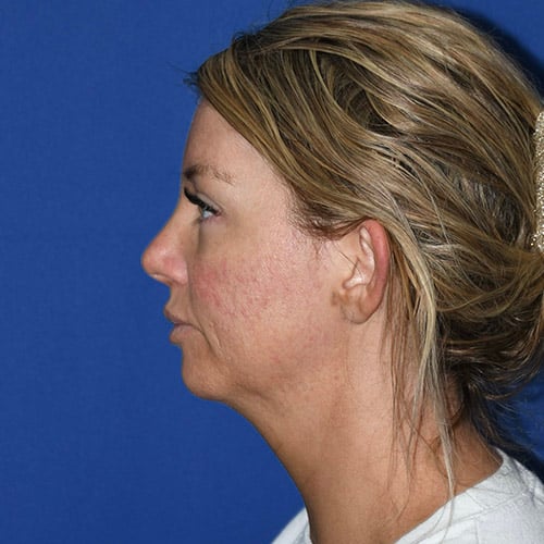 left side view before otoplasty and chin liposuction by dr papillion 12555